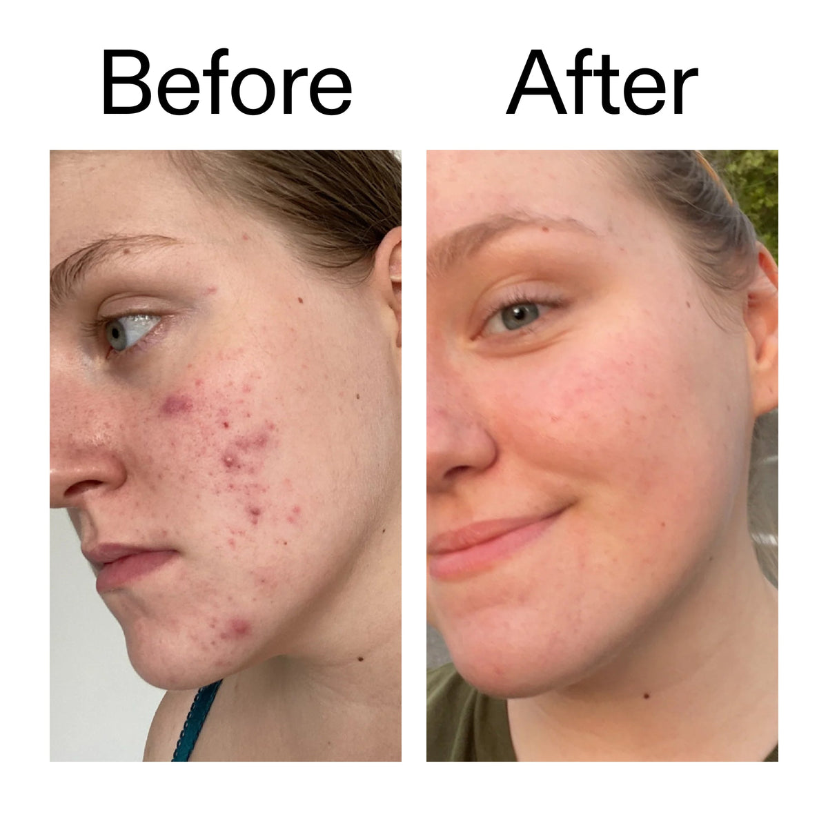 15-vitamin-c-egf-serum-c6 15_Vitamin_C_EGF_Serum_Before_After_2000x2000_fb9f598a-3386-40c8-8143-36f9d7a17ec8.jpg