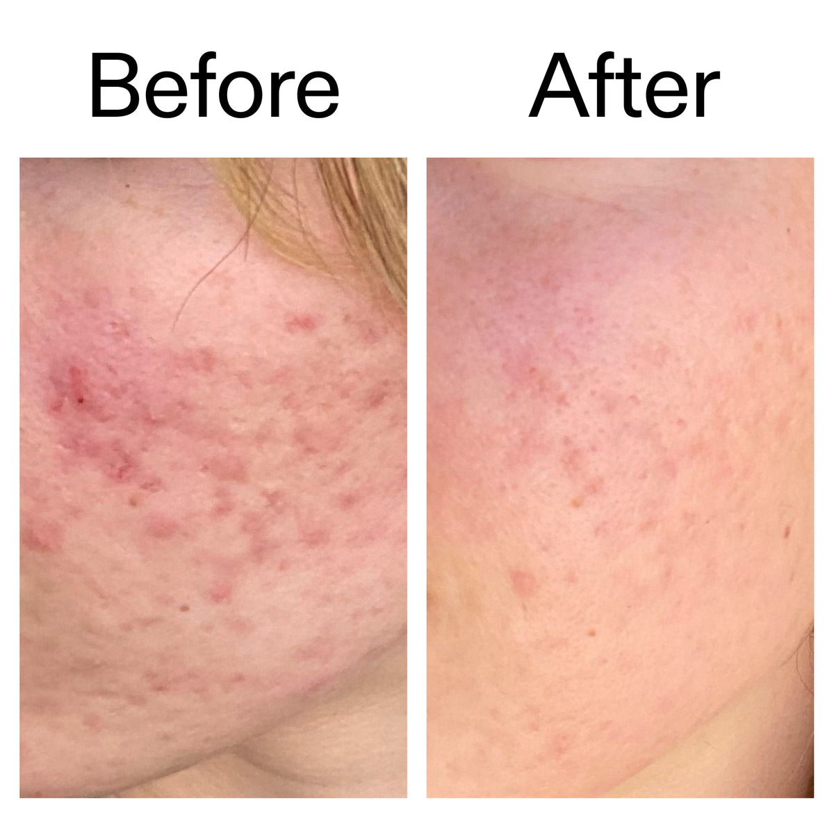 10-azelaic-acid-serum-for-redness-relief-f3 Azealic_Acid_Serum_B_A_Ppage_2000_x_2000.jpg