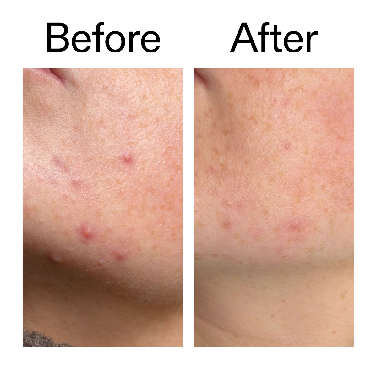 10-azelaic-acid-serum-for-redness-relief-f3 B_A_1_PPAGE.png