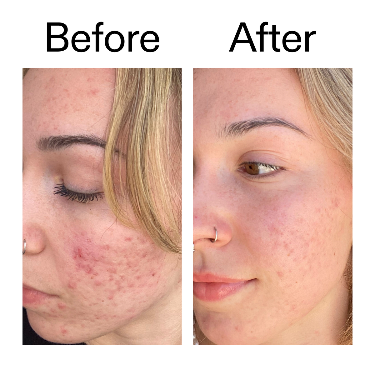 10-azelaic-acid-serum-for-redness-relief-f3 B_A_2_PPAGE.png