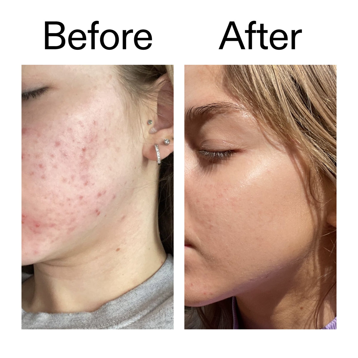 beta-hydroxy-acid-bha-serum-m5 Beta_Hydroxy_Acid_Serum_Before_After_2000x2000_96fda3e5-938d-49ef-bcf2-a0fa6ece4e2c.jpg