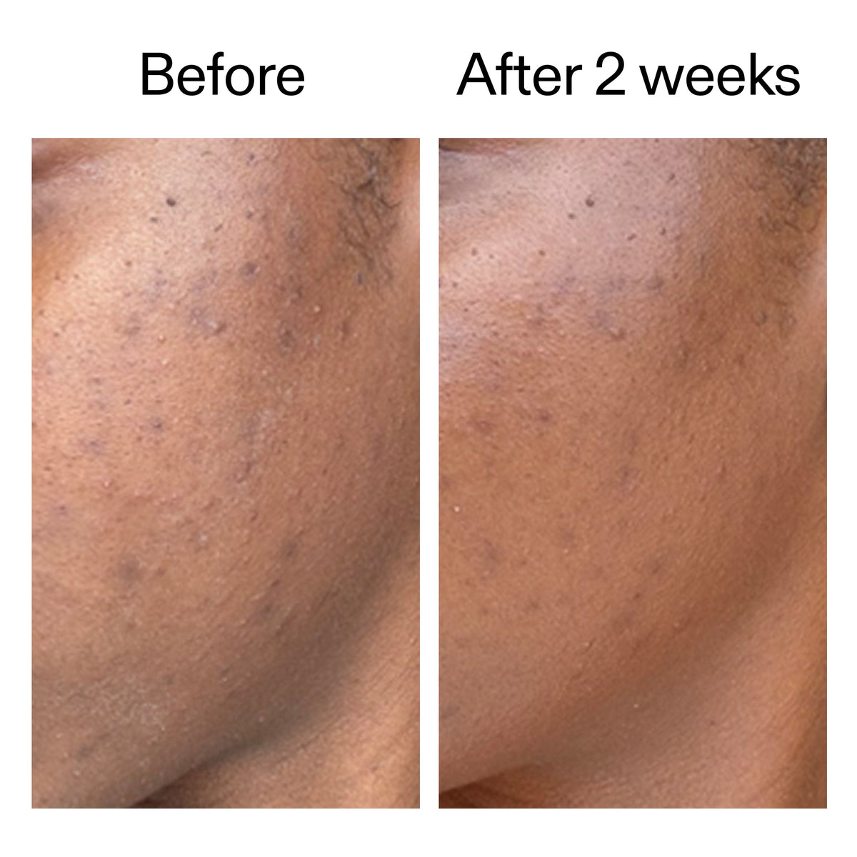 360-acne-clearing-duo-o1 DIOICB_A2000x2000.jpg