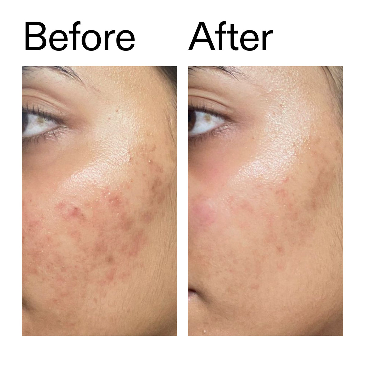 ectoin-hydro-barrier-serum-g1 Ectoin_Hydro-barrier_Serum__Before_After_2000x2000_34261920-d004-48d0-9c7b-8e1c15971bfd.jpg
