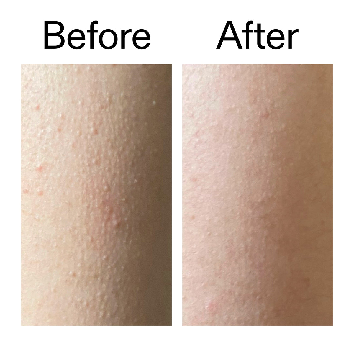 glycolic-acid-exfoliating-body-stick-r7 Glycolic_Acid_Exfoliating_Body_Stick_Before_After_V2_2000x2000_2e4ba052-94f6-4d56-82df-7bdb5b2df7ae.jpg