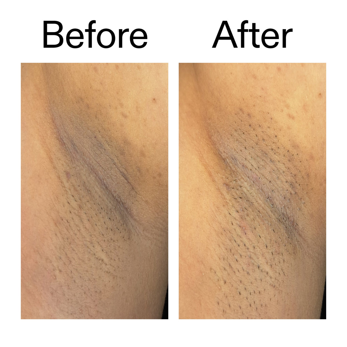 glycolic-acid-exfoliating-body-stick-r7 Glycolic_Acid_Exfoliating_Body_Stick_Before_After_V3_2000x2000_ea919cd9-1439-4a46-82a0-76200eb5bb42.jpg