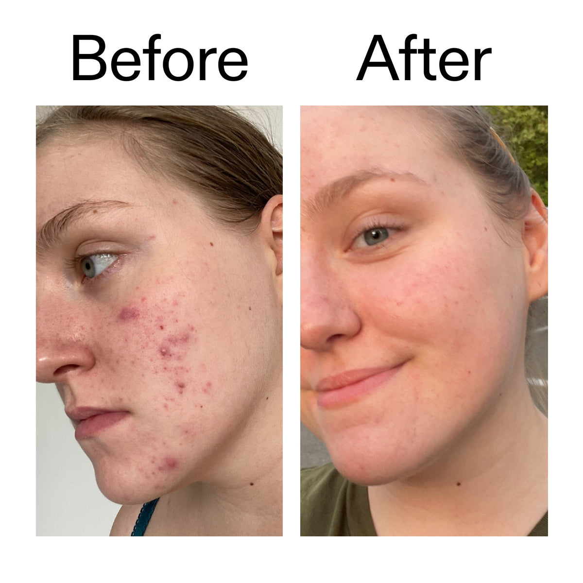 glycolic-acid-toner-e3 Glycolic_Acid_Toner_Before_After_2000x2000_49f0b9f7-e71b-4b2e-a8f8-2ea4b73247bb.jpg