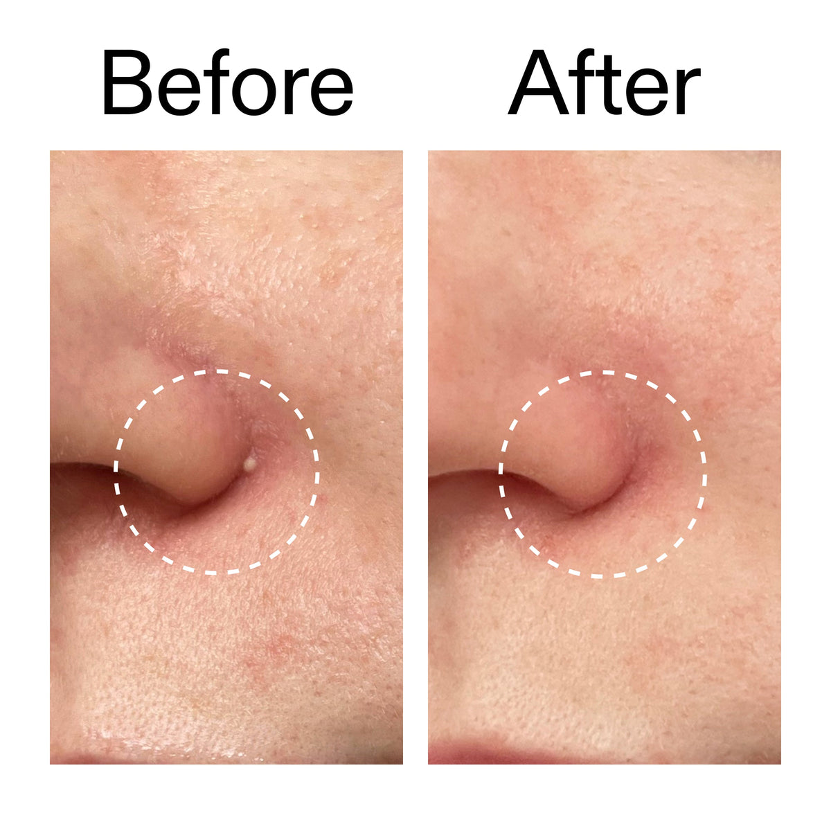 hydrocolloid-invisible-pimple-patches-pack-of-22-t6 Hydrocolloid_Invisible_Pimple_Patches_Before_After_2000x2000_b02aa37b-c78a-4682-91de-9135af5bb7df.jpg