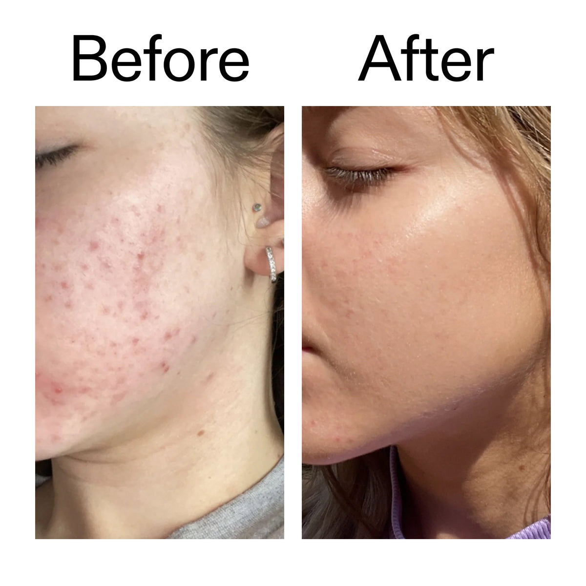 10-niacinamide-serum-duo-i4 Niacinamide_Serum_Before_After_2000x2000_bde32455-9e7d-448e-b053-bef41504f0a9.jpg