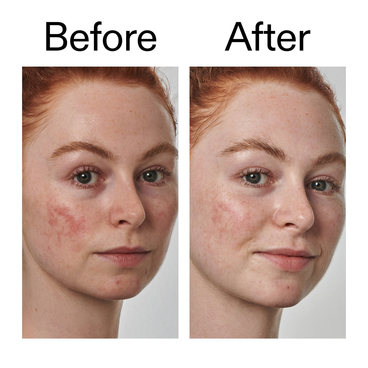 10-azelaic-acid-serum-for-redness-relief-f3 Redness_Relief_Serum_Before_After_2000x2000_3334dc9a-cce9-4e00-8aec-7ad89ca051f2.jpg