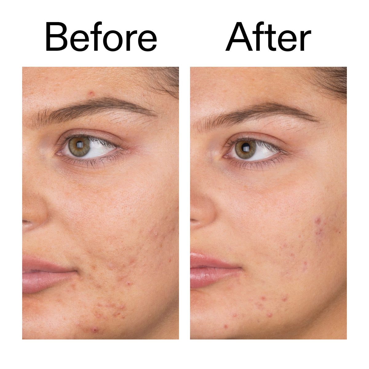 salicylic-acid-cleanser-150ml-f0 Salicylic_Acid_Cleanser_-_150ml_Before_After_2000x2000_e7230494-853f-4b07-82b1-27669104c995.jpg
