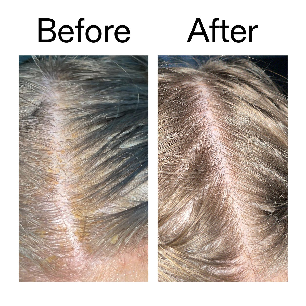 salicylic-acid-exfoliating-scalp-treatment-f1 Salicylic_Acid_Exfoliating_Scalp_Treatment_Before_After_2000x2000_e572a30f-057c-4a48-823b-1c09dc97f8d0.jpg