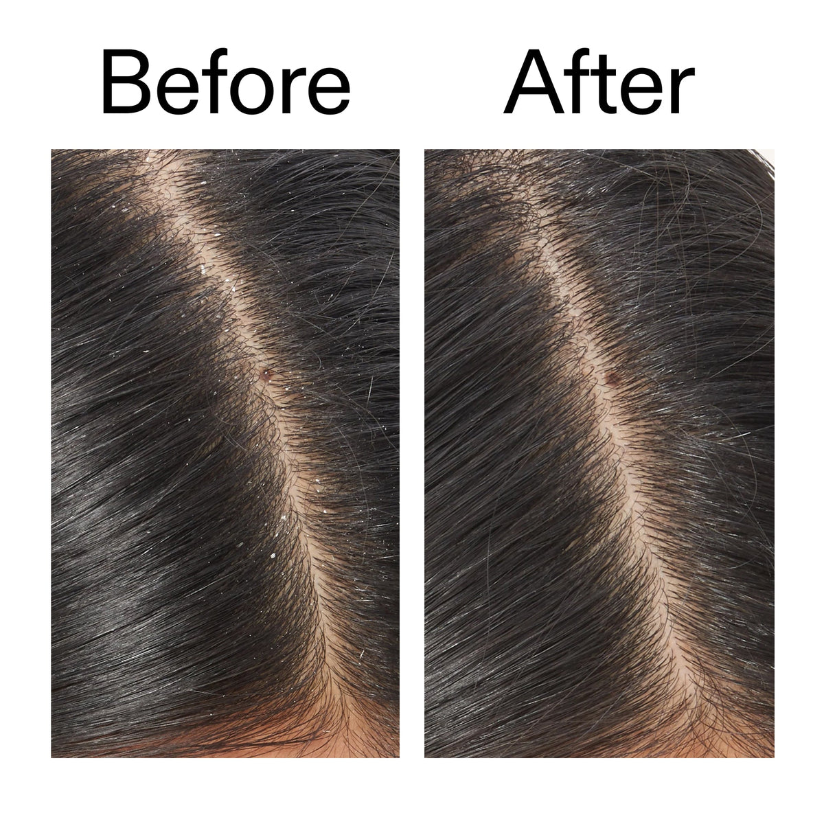salicylic-acid-exfoliating-scalp-treatment-f1 Salicylic_Acid_Exfoliating_Scalp_Treatment_Before_After_V2_2000x2000_02bd61ad-42bf-490b-b3e3-7e04b2e8a673.jpg