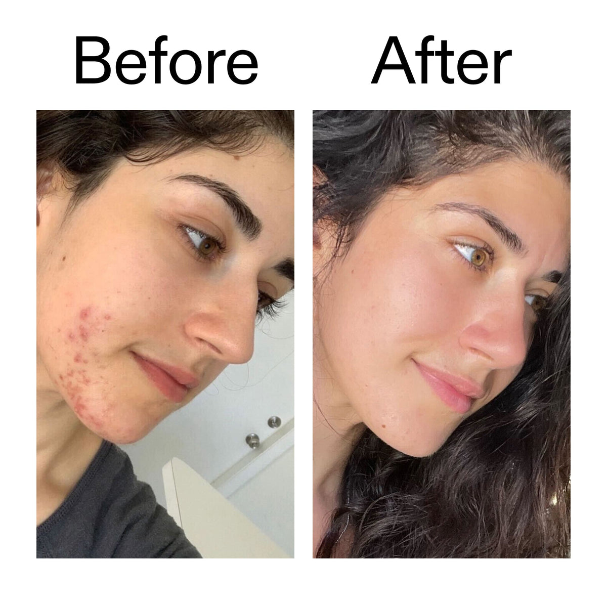 succinic-acid-acne-treatment-m8 Succinic_Acid_Treatment_Before_After_2000x2000_6a5f0054-2f58-4433-9314-0dc72c9bdd3b.jpg